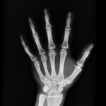 hand x ray result