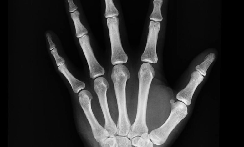 hand x ray result